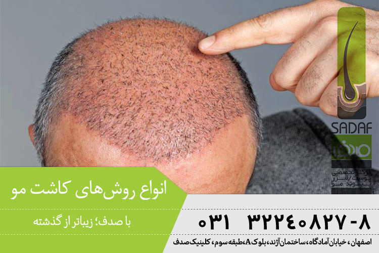 انواع روش های کاشت موی در اصفهان