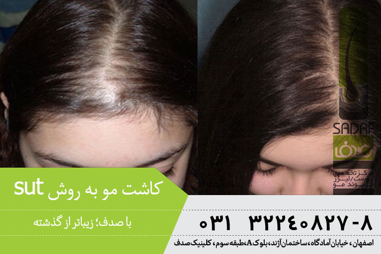 بهترین کاشت مو به روش اس یو تی در اصفهان