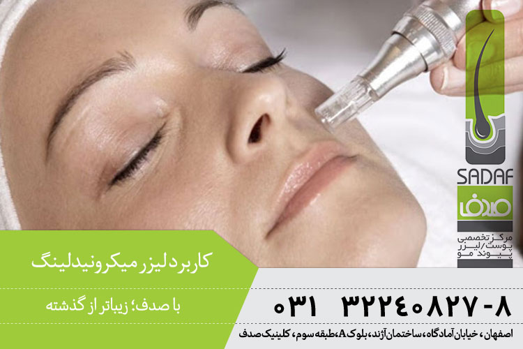 کاربرد میکرونیدلینگ در اصفهان