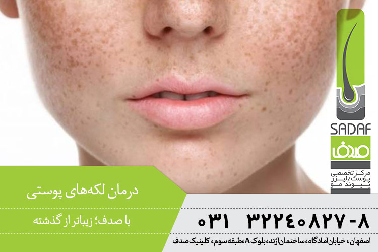 بهترین درمان لکه‌های پوستی در اصفهان
