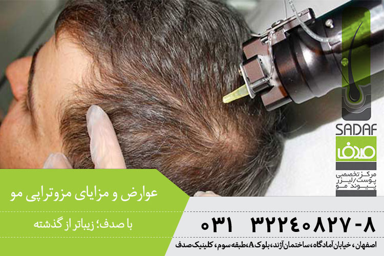 بررسی مزایا و معیایب مزوتراپی مو در کلینیک صدف اصفهان