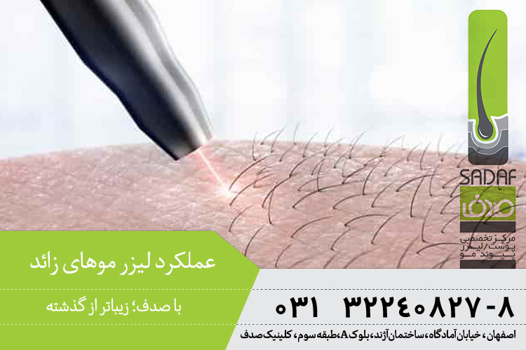 عملکرد لیزر موهای زائد در کلینیک صدف اصفهان 