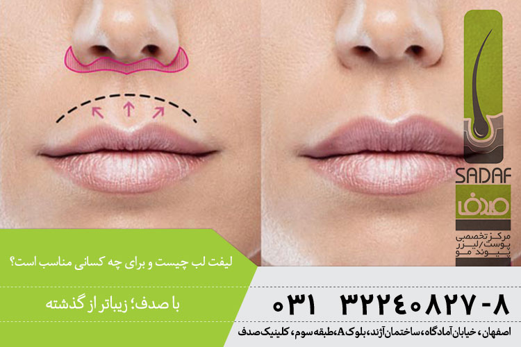 جراحی لیفت لب ، کلینیک صدف