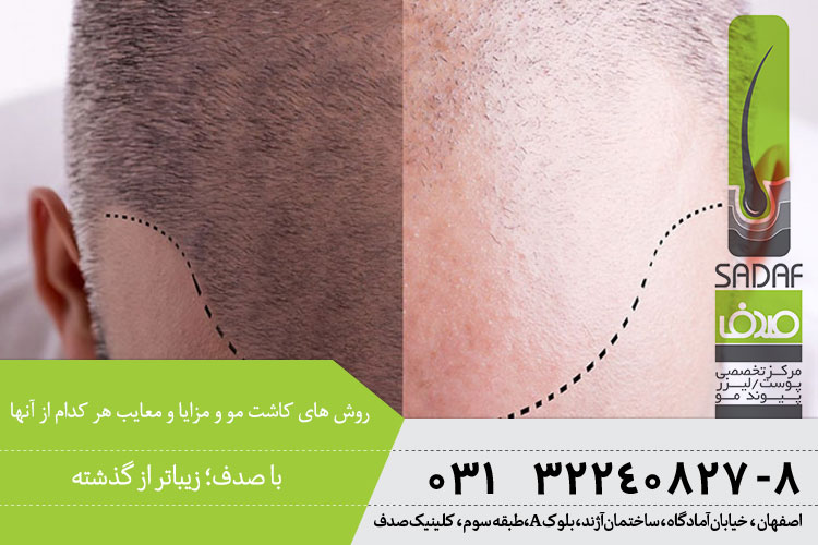 کاشت مو و انواع روش های آن در اصفهان