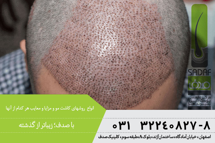 معایب و مزایای روشهای کاشت مو | بهترین متخصص پوست در اصفهان