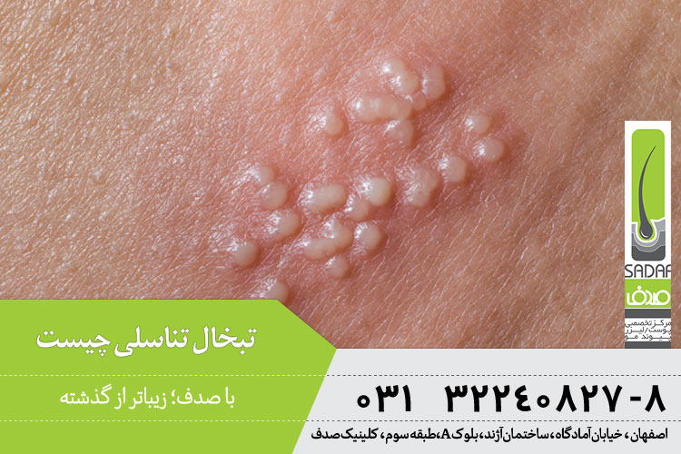 تبخال تناسلی چیست و چگونه درمان میشود؟