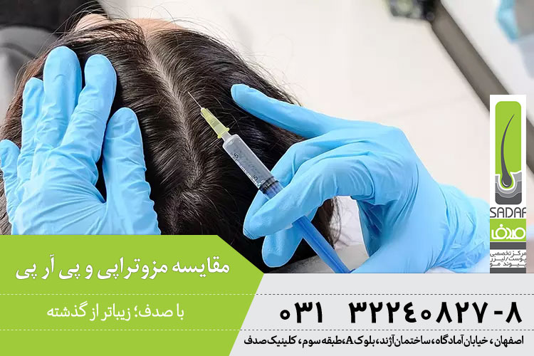 مقایسه مزوتراپی و پی آر پی 