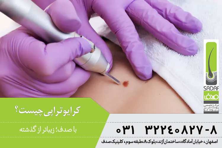 کرایوتراپی یا سرما درمانی