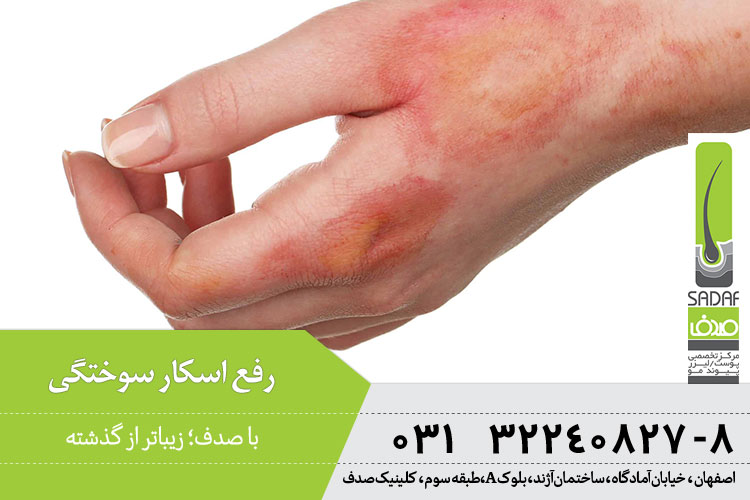 رفع اسکار سوختگی