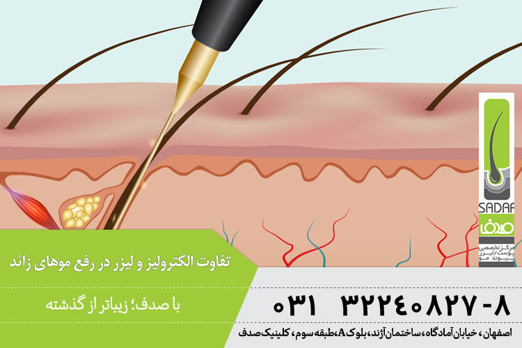 تفاوت الکترولیز و لیزر در رفع موهای زائد