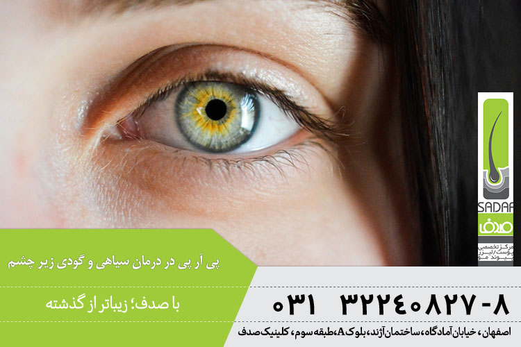 تأثیر پی آر پی در درمان سیاهی و گودی زیر چشم