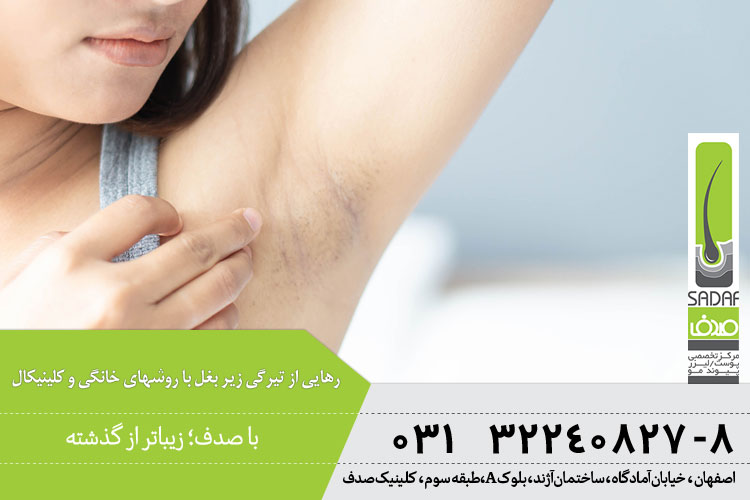 رهایی از تیرگی زیر بغل