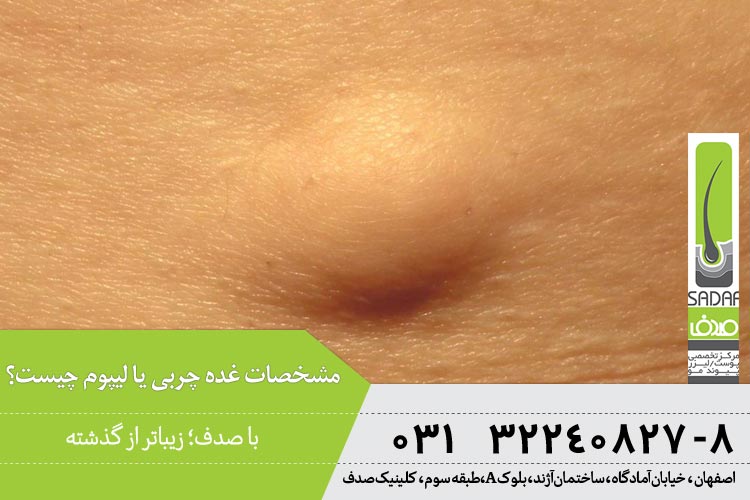 مشخصات غده چربی یا لیپوم