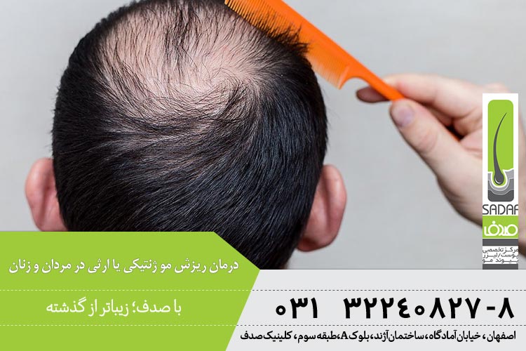 درمان ریزش مو ژنتیکی یا ارثی در مردان و زنان