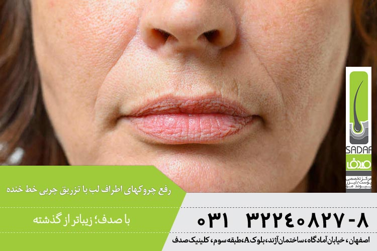 رفع چروکهای اطراف لب با تزریق چربی خط خنده