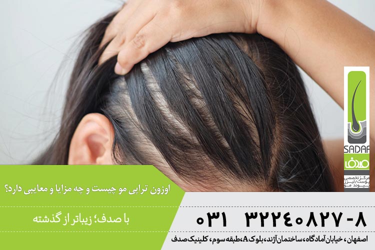 اوزون تراپی مو