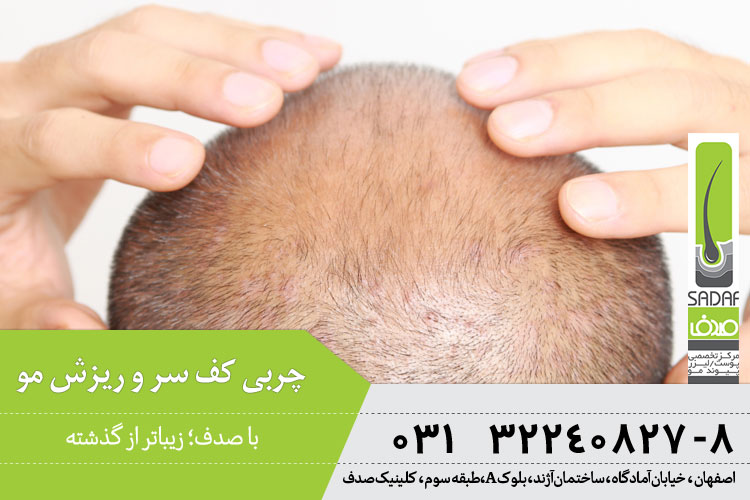 چربی کف سر و ریزش مو