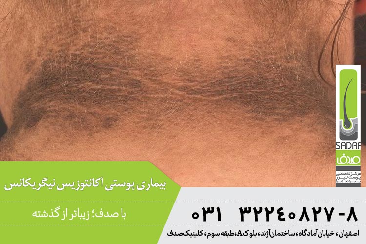 بیماری پوستی آکانتوزیس نیگریکانس