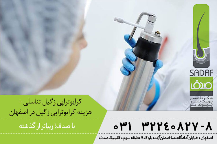 کرایوتراپی زگیل تناسلی