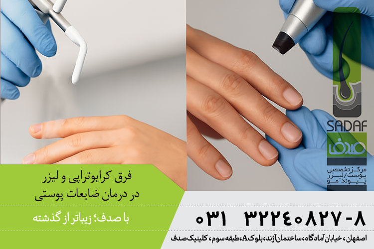کرایوتراپی بهتر است یا لیزر