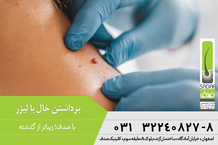 برداشتن خال با لیزر در اصفهان