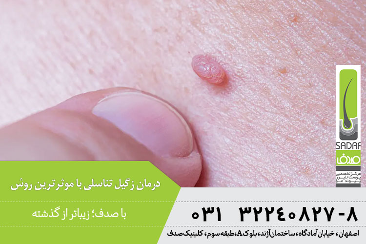 درمان زگیل تناسلی 