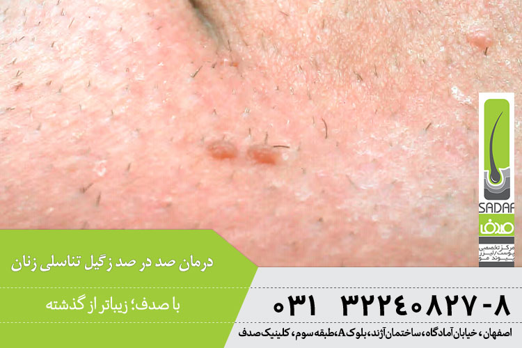 درمان زگیل تناسلی زنان 