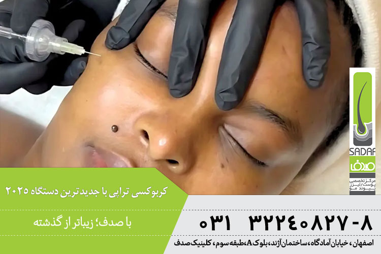 هزینه کربوکسی تراپی اصفهان 