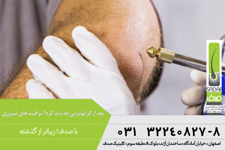 مراقبت های بعد از کرایوتراپی 