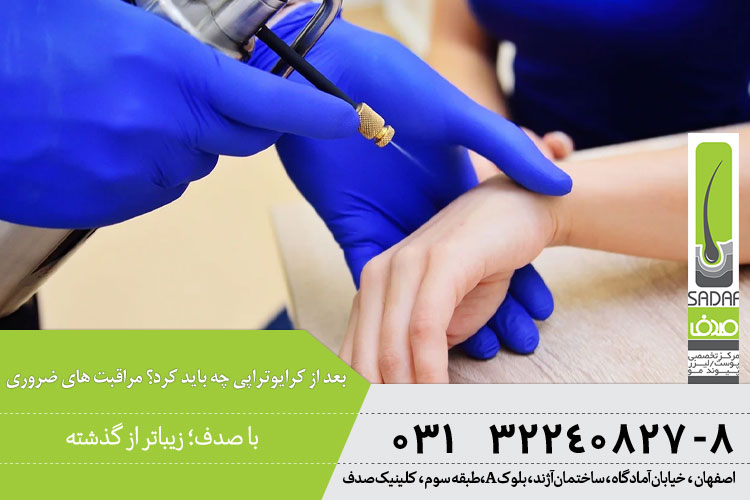 مراقبت های ضروری بعد از کرایوتراپی