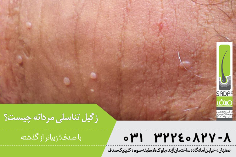 زگیل تناسلی مردان