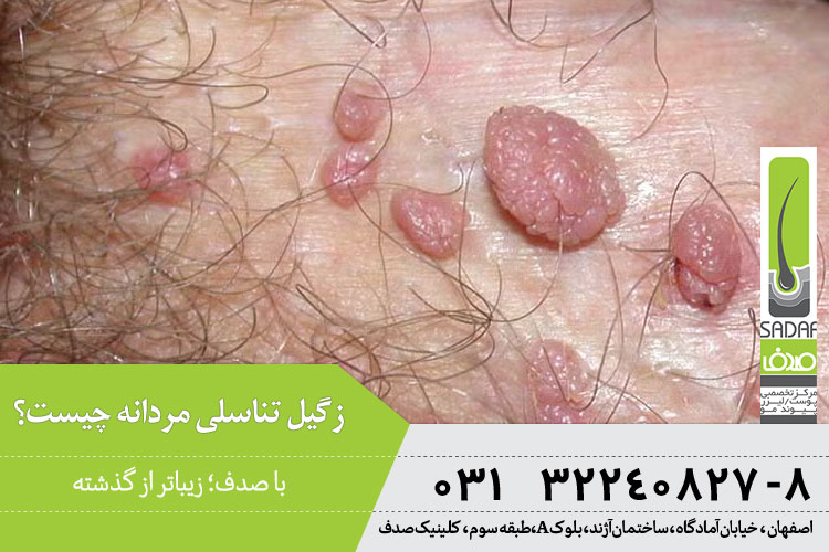 زگیل تناسلی مردانه چیست؟