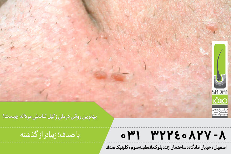 درمان زگیل تناسلی مردان