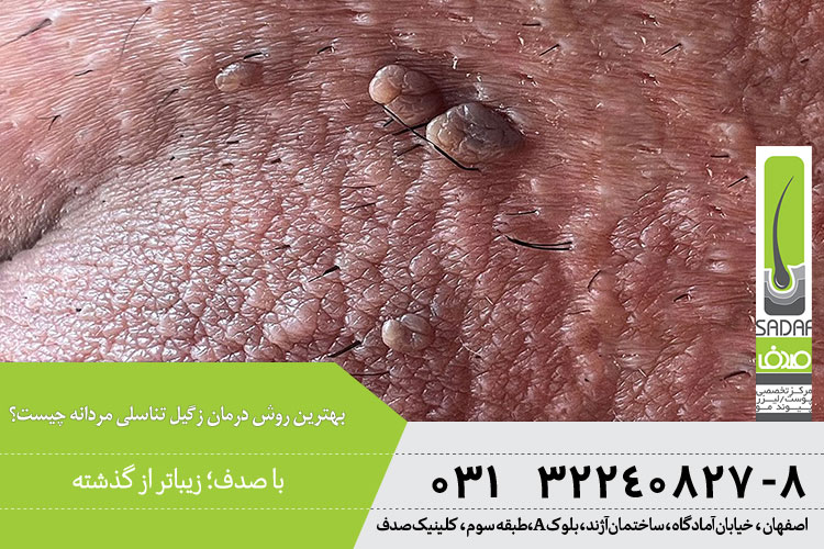 درمان زگیل تناسلی مردان در اصفهان