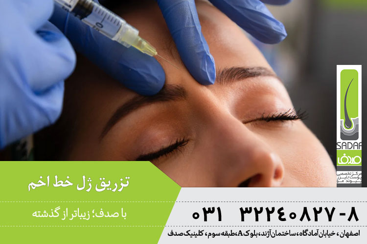 تزریق ژل خط اخم 