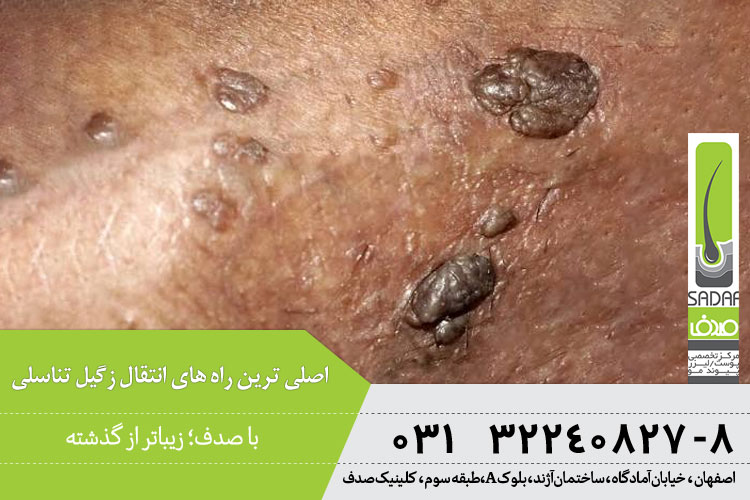 راه های انتقال زگیل تناسلی 