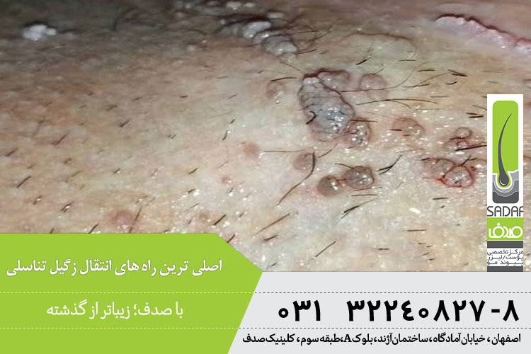 مدت زمان انتقال زگیل تناسلی 