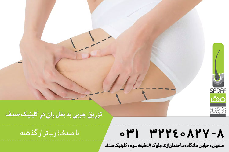 ماندگاری تزریق چربی به هیپ دیپ در اصفهان