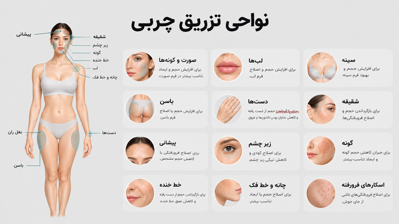 نواحی تزریق چربی
