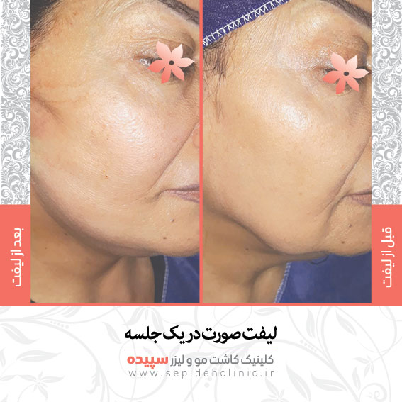 نمونه کار هایفو دکتر اکبر مزروعی بهترین  متخصص پوست مو و زیبایی اصفهان