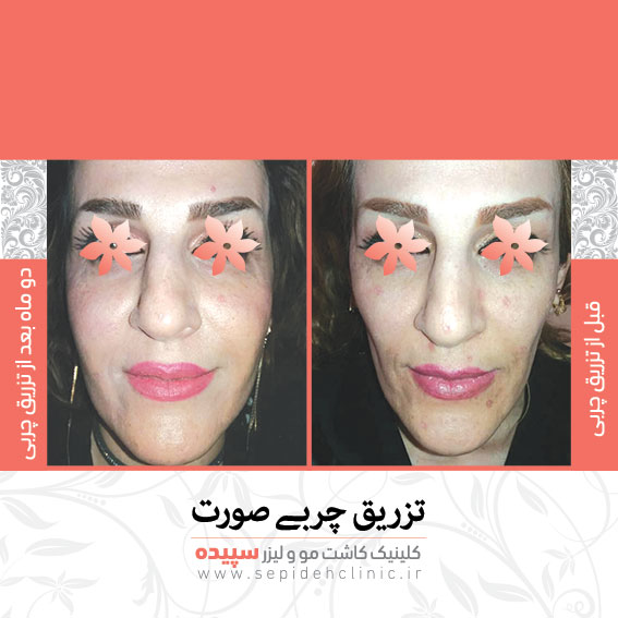 نمونه تزریق چربی صورت و گونه جوانسازی صورت کلینیک سپیده اصفهان دکتر اکبر مزوعی 