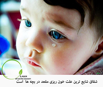 شقاق در بچه ها,درمان شقاق در بچه ها ,شقاق,درمان جراحی شقاق در کودکان,درمان قطعی شقاق بچه ها