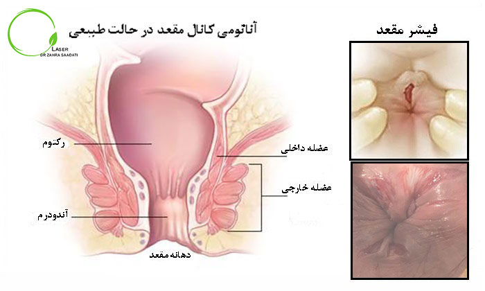 تشخیص آنال فیشر