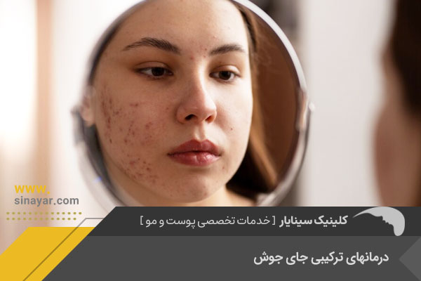 درمان های ترکیبی جای جوش در اصفهان
