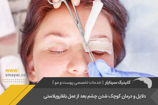 درمان کوچک شدن چشم بعد از عمل بلفاروپلاستی