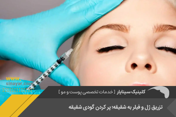 تزریق فیلر به گودی شقیقه در اصفهان