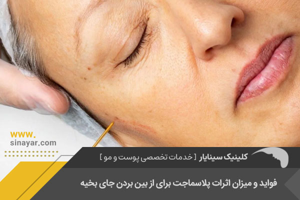 پلاسما جت برای از بین بردن جای بخیه