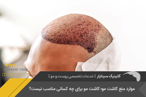 چه کسانی نمیتوانند کاشت مو انجام دهند؟