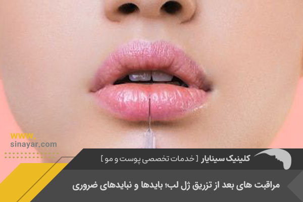 مراقبت های بعد از تزریق ژل لب