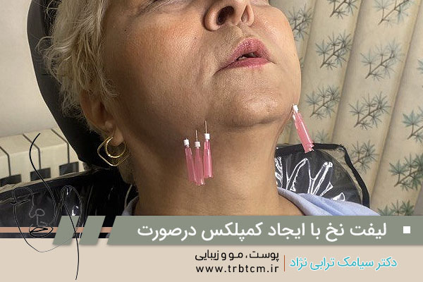 عکسهای لیفت صورت با نخ